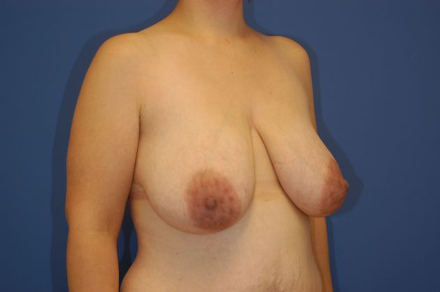 Breast Reduction Patient Photo - Case 12 - before view-1