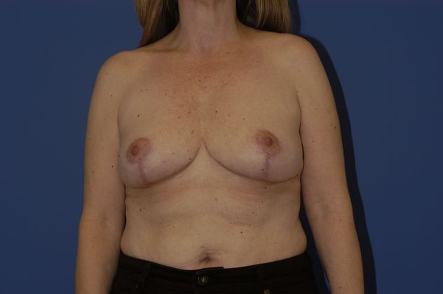 Breast Reduction Patient Photo - Case 13 - after view