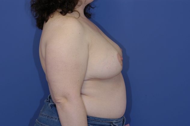 Breast Reduction Patient Photo - Case 14 - after view-2