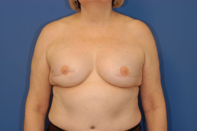 Breast Reconstruction - Case 12 - After