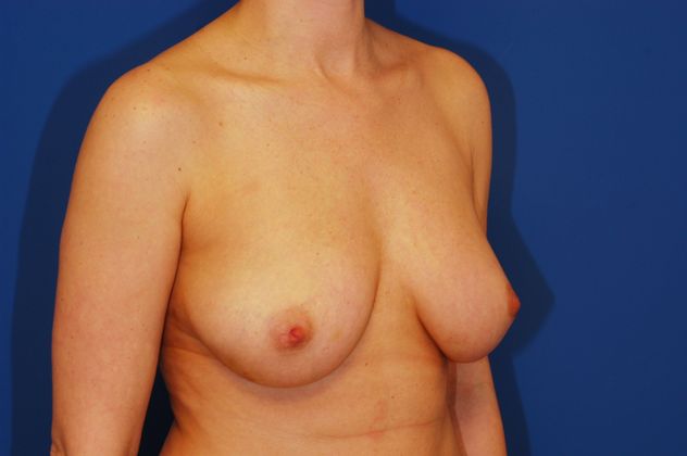 Breast Reconstruction Patient Photo - Case 13 - before view-1