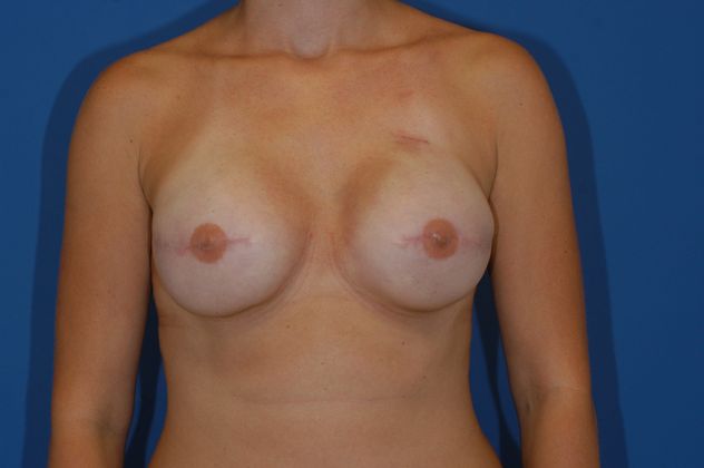 Breast Reconstruction - Case 13 - After
