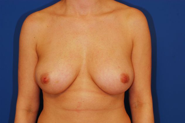 Breast Reconstruction Patient Photo - Case 13 - before view-