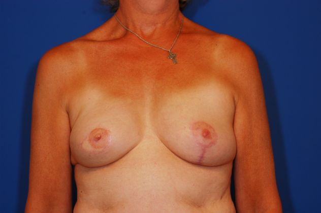 Breast Reconstruction - Case 14 - After