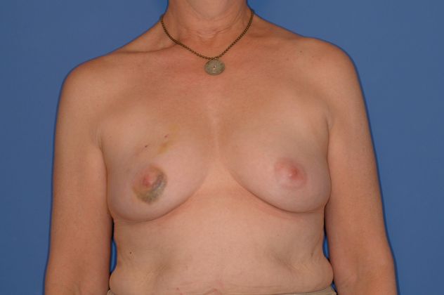 Breast Reconstruction - Case 14 - Before
