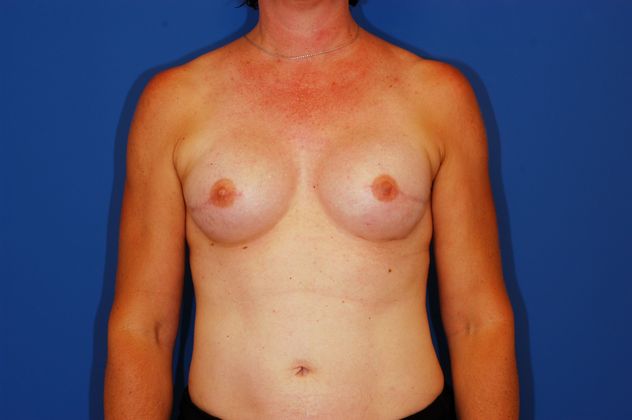 Breast Reconstruction Patient Photo - Case 15 - after view