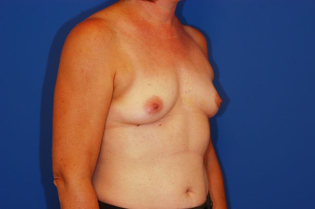 Breast Reconstruction Patient Photo - Case 15 - before view-1