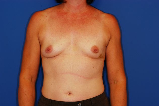 Breast Reconstruction Patient Photo - Case 15 - before view-0