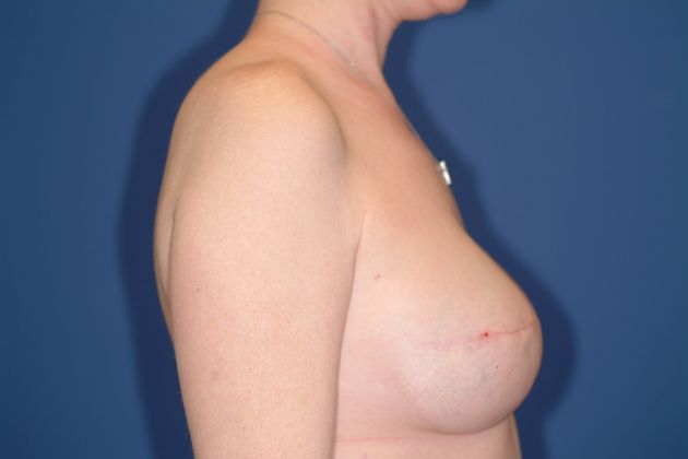 Breast Reconstruction Patient Photo - Case 16 - before view-1