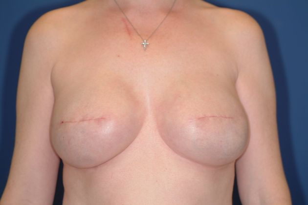 Breast Reconstruction Patient Photo - Case 16 - after view