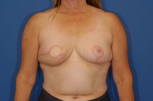 Breast Reconstruction - Case 18 - After