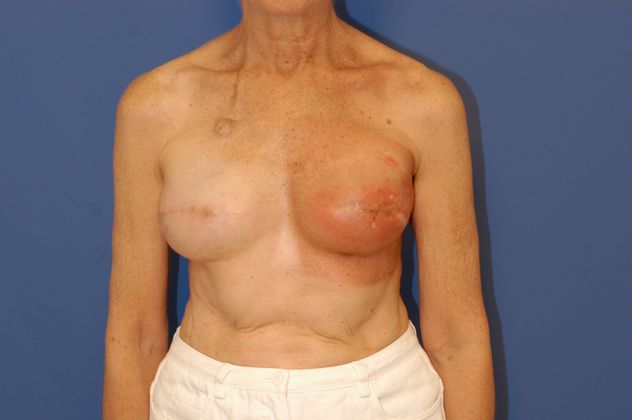 Breast Reconstruction Patient Photo - Case 19 - before view-