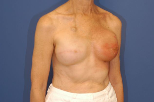 Breast Reconstruction Patient Photo - Case 19 - before view-1