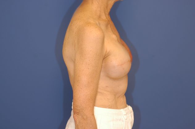 Breast Reconstruction Patient Photo - Case 19 - before view-2