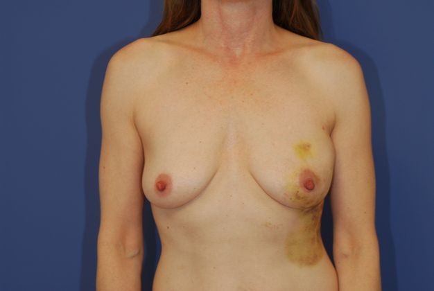 Breast Reconstruction Patient Photo - Case 17 - before view-0