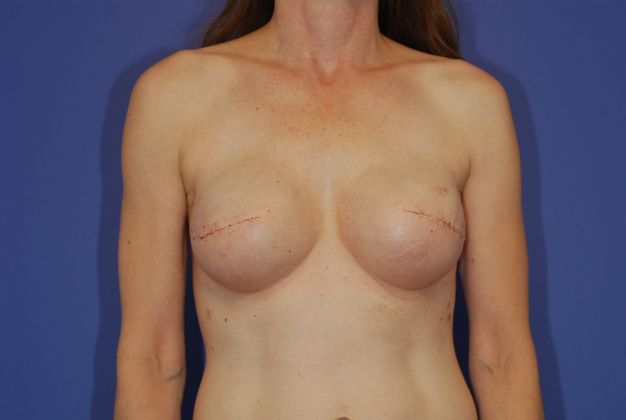 Breast Reconstruction - Case 17 - After