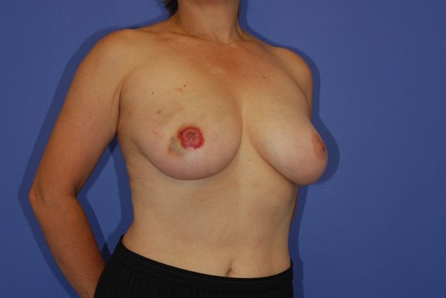 Breast Reconstruction Patient Photo - Case 10 - before view-1