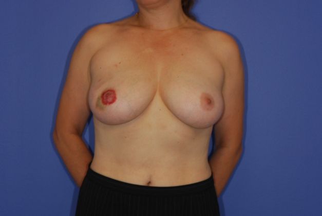 Breast Reconstruction Patient Photo - Case 10 - before view-