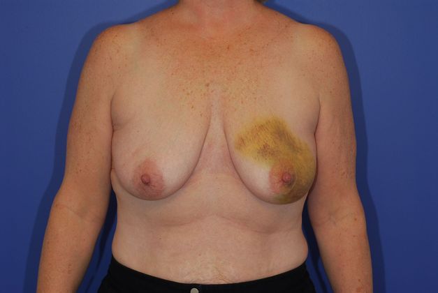 Breast Reconstruction Patient Photo - Case 21 - before view-