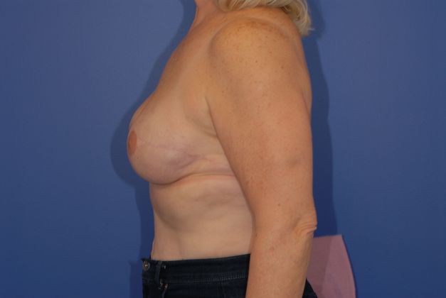 Breast Reconstruction Patient Photo - Case 21 - after view-2