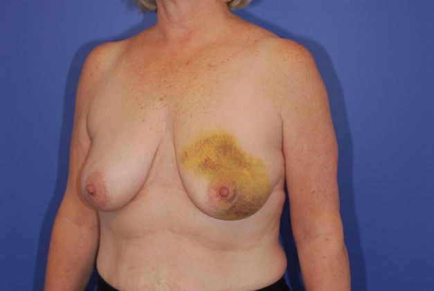 Breast Reconstruction Patient Photo - Case 21 - before view-1