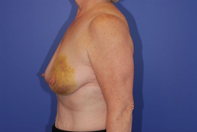 Breast Reconstruction Patient Photo - Case 21 - before view-2
