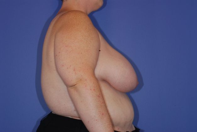 Breast Reconstruction Patient Photo - Case 23 - before view-2
