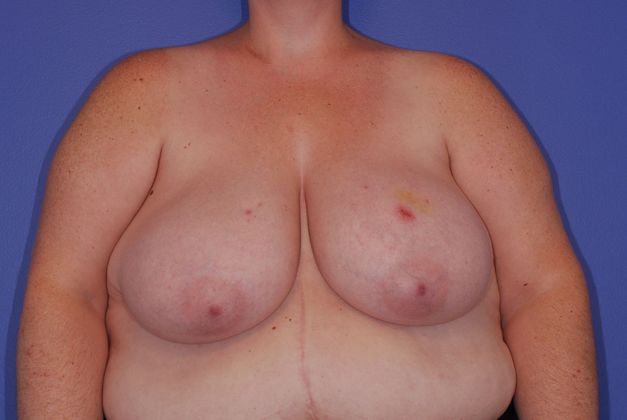 Breast Reconstruction Patient Photo - Case 23 - before view-