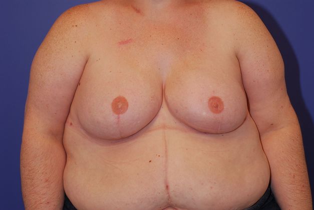 Breast Reconstruction Patient Photo - Case 23 - after view