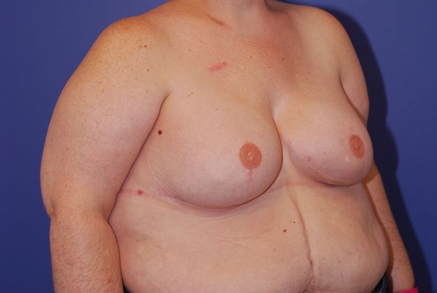 Breast Reconstruction Patient Photo - Case 23 - after view-1