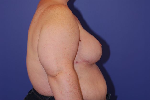 Breast Reconstruction Patient Photo - Case 23 - after view-2