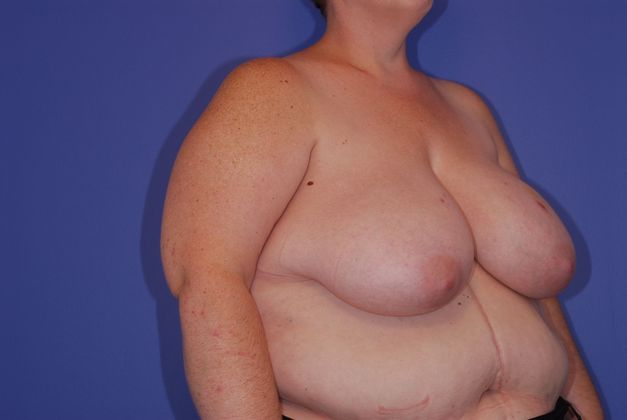Breast Reconstruction Patient Photo - Case 23 - before view-1