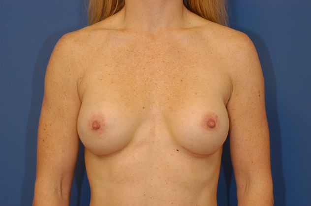 Breast Augmentation Patient Photo - Case 11 - after view