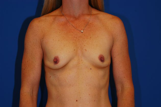 Breast Augmentation Patient Photo - Case 11 - before view-