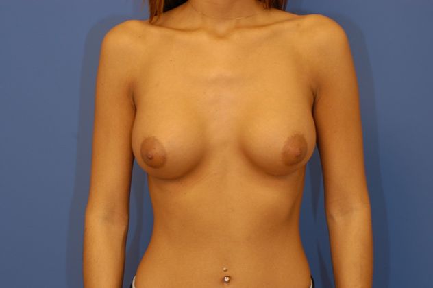 Breast Augmentation Patient Photo - Case 12 - after view