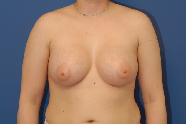 Breast Augmentation Patient Photo - Case 14 - after view