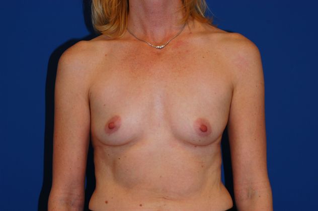 Breast Augmentation Patient Photo - Case 16 - before view-0