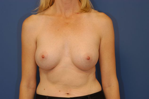 Breast Augmentation - Case 16 - After