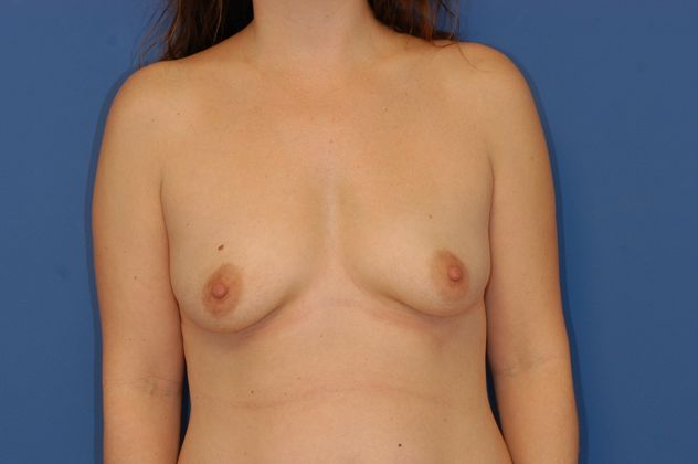 Breast Augmentation - Case 17 - Before