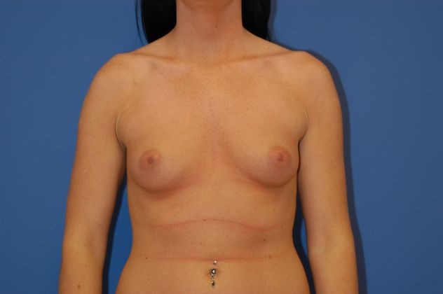 Breast Augmentation Patient Photo - Case 18 - before view-0
