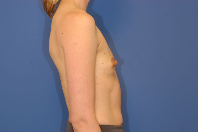 Breast Augmentation Patient Photo - Case 19 - before view-2