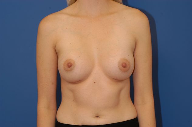 Breast Augmentation Patient Photo - Case 19 - after view-0