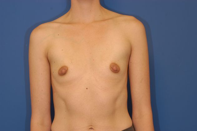 Breast Augmentation Patient Photo - Case 19 - before view-0