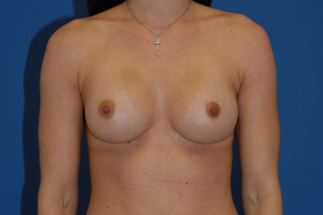 Breast Augmentation Patient Photo - Case 20 - after view