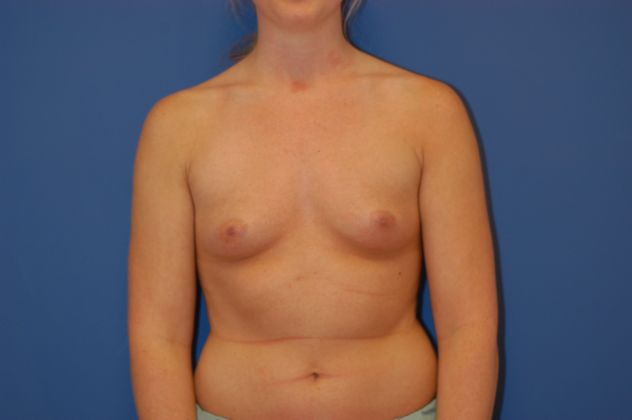 Breast Augmentation Patient Photo - Case 21 - before view-0