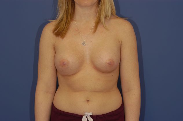 Breast Augmentation Patient Photo - Case 21 - after view