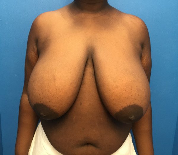 Breast Reduction - Case 1889 - Before