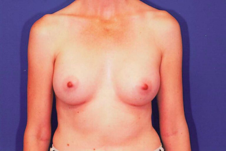 Breast Augmentation - Case 1960 - After