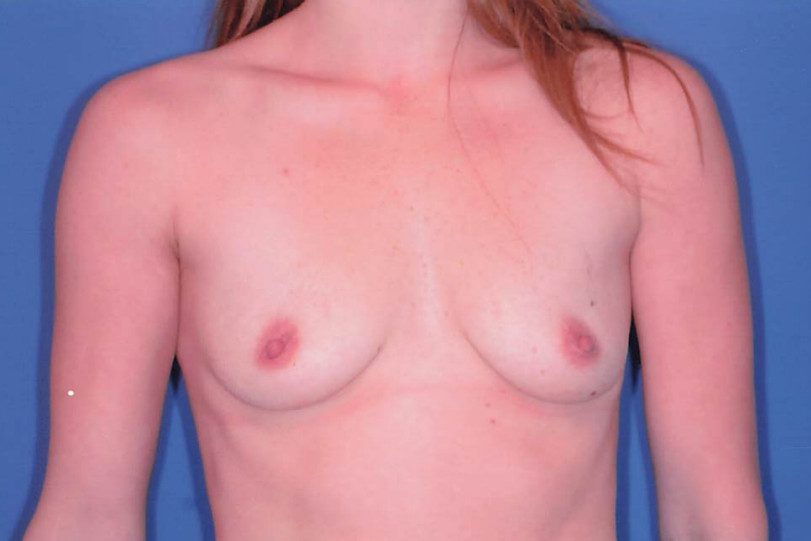 Breast Augmentation Patient Photo - Case 1965 - before view-0