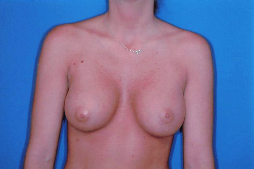 Breast Augmentation Patient Photo - Case 1970 - after view